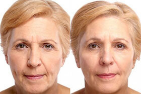 Photo 3 before and after application of the cream goji