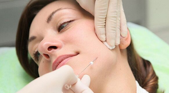 Thread lifting - a method for cosmetic rejuvenation of the face after 45 years