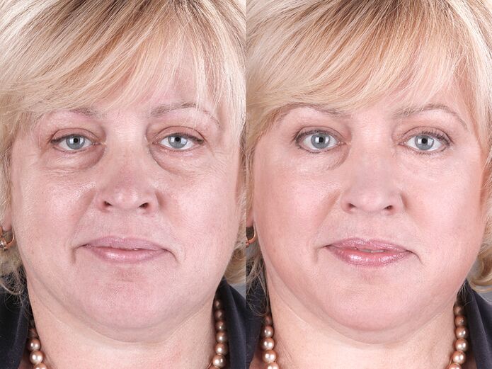 before and after using the rejuvenating massager ltza photo 3
