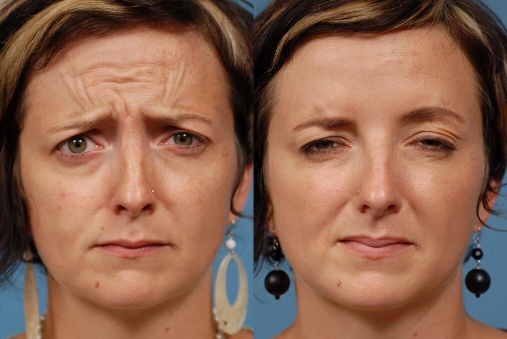 before and after using the rejuvenation massager ltza photo 2