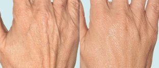 Skin of the hands before and after fractional therapy